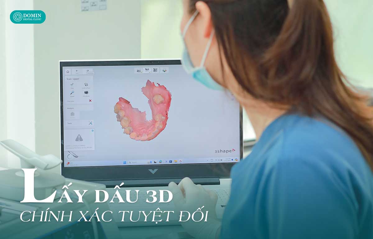 Công nghệ áp dụng quyết định đến chi phí dán sứ veneer