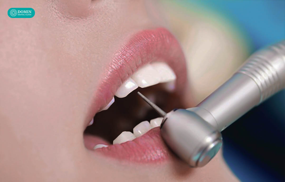 Quy trình dán sứ veneer tại nha khoa Domin đảm bảo mài răng tối thiểu