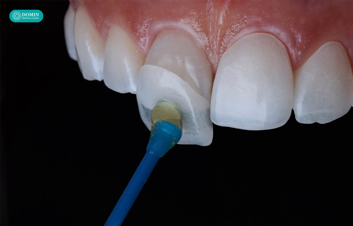 Veneer được gắn bằng vật liệu chuyên dụng.