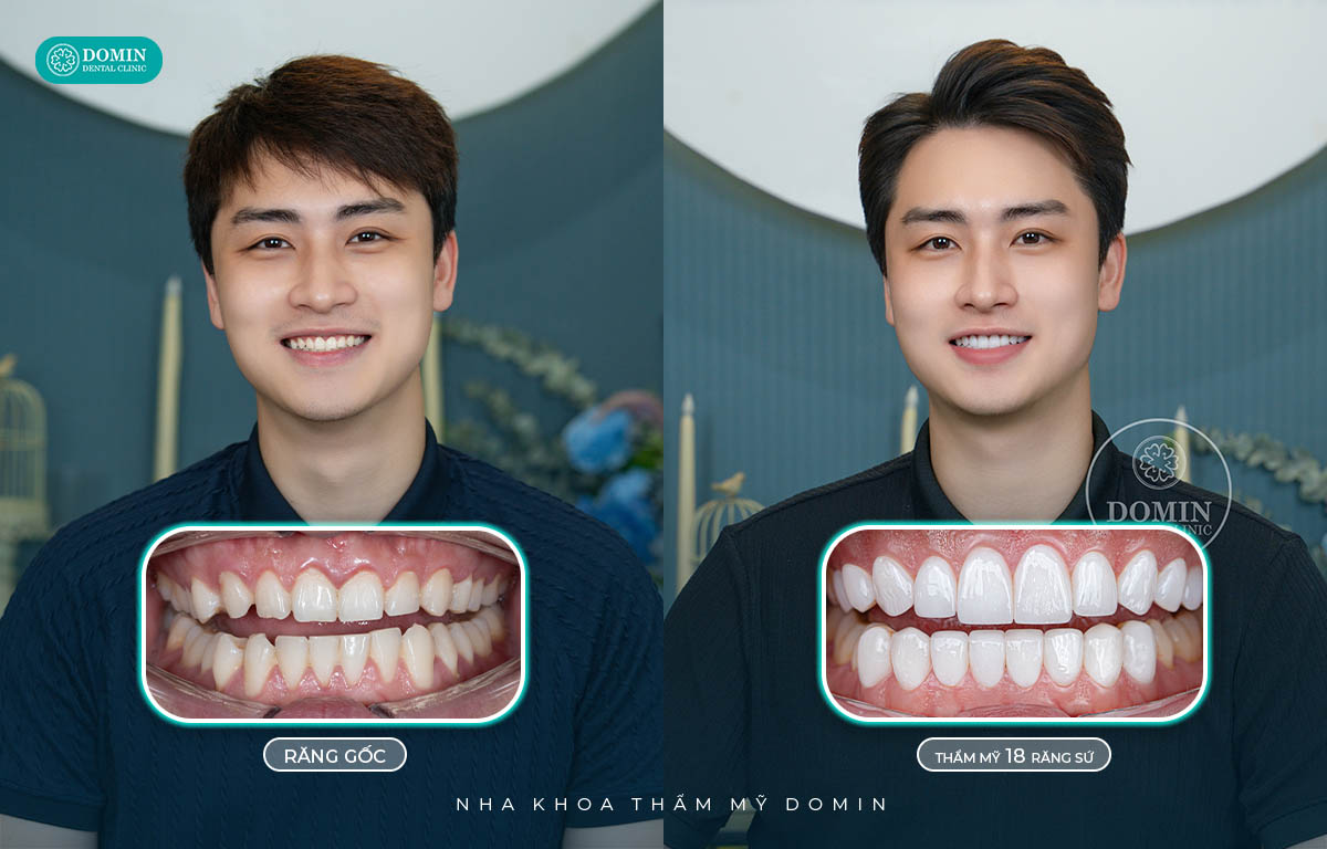 Dán sứ veneer đảm bảo thẩm mỹ, chức năng và bảo tồn răng thật.