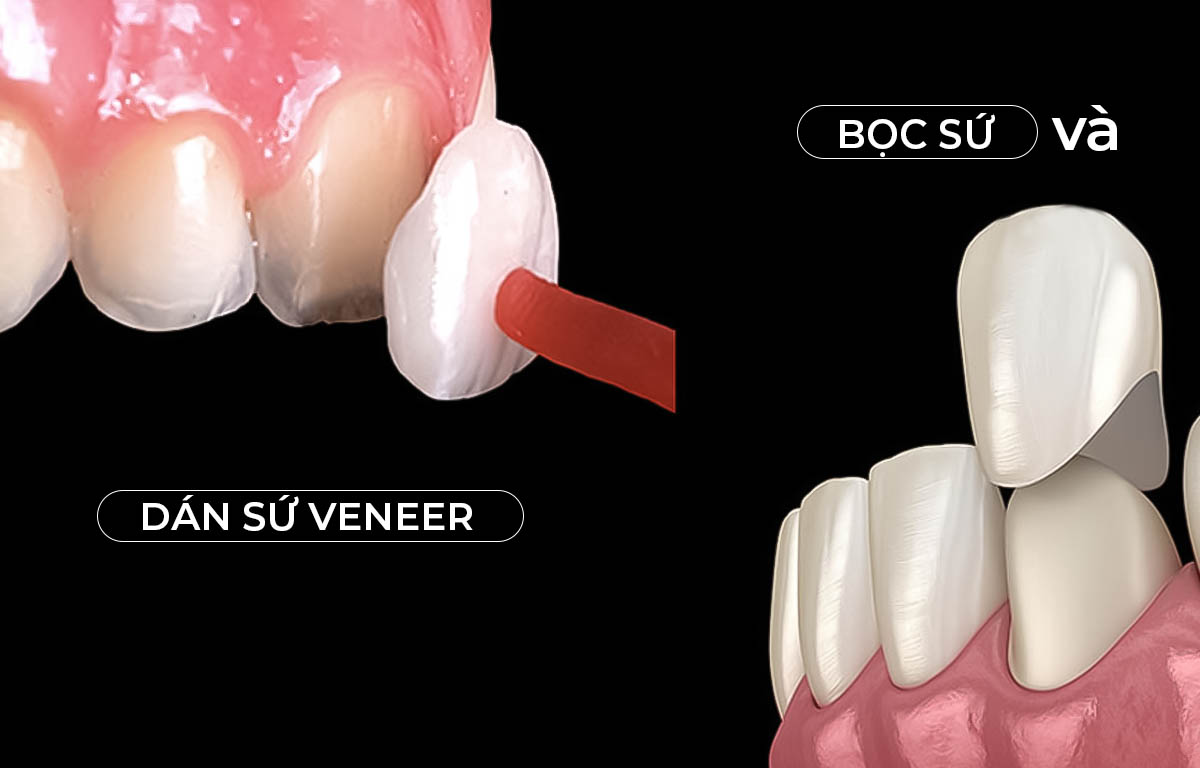 Nhiều người nhẫm lẫn bọc sứ và dán sứ veneer
