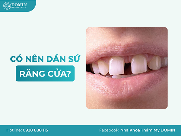 Có Nên Dán Sứ Veneer Răng Cửa Không? Liệu Có Hiệu Quả?