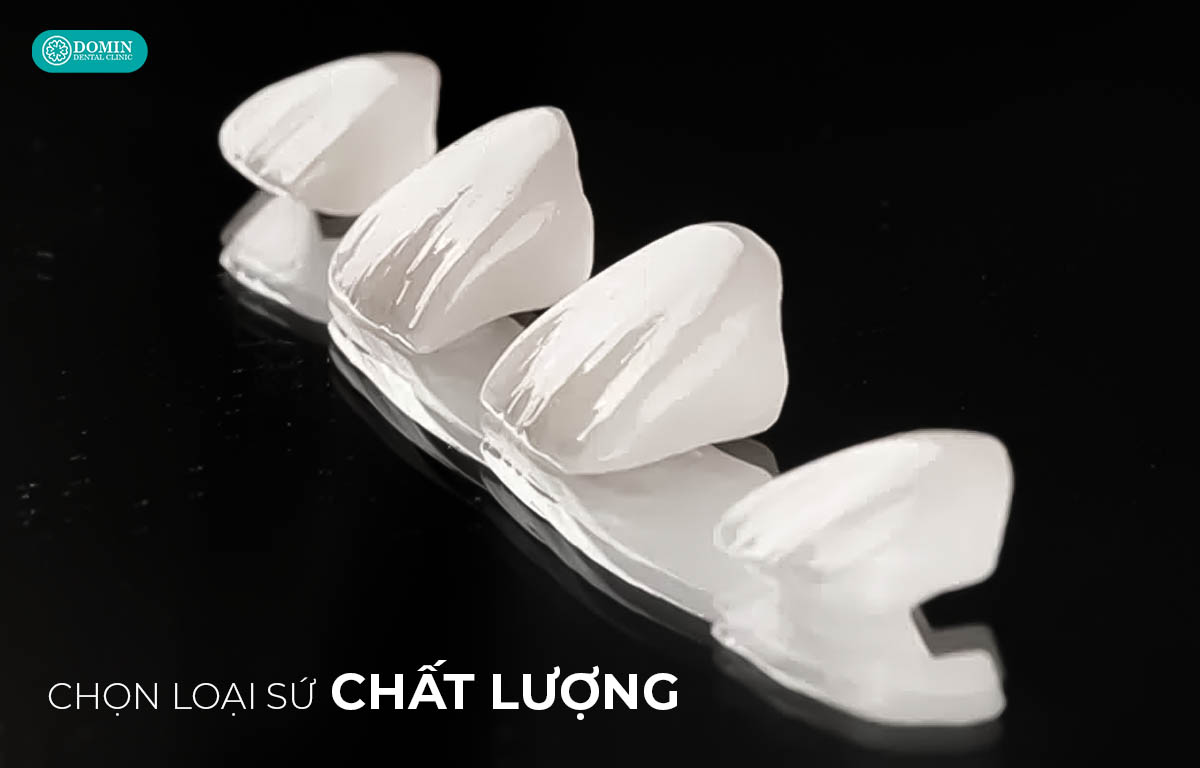 Nên chọn mặt dán sứ chất lượng cao để đảm bảo an toàn, thẩm mỹ