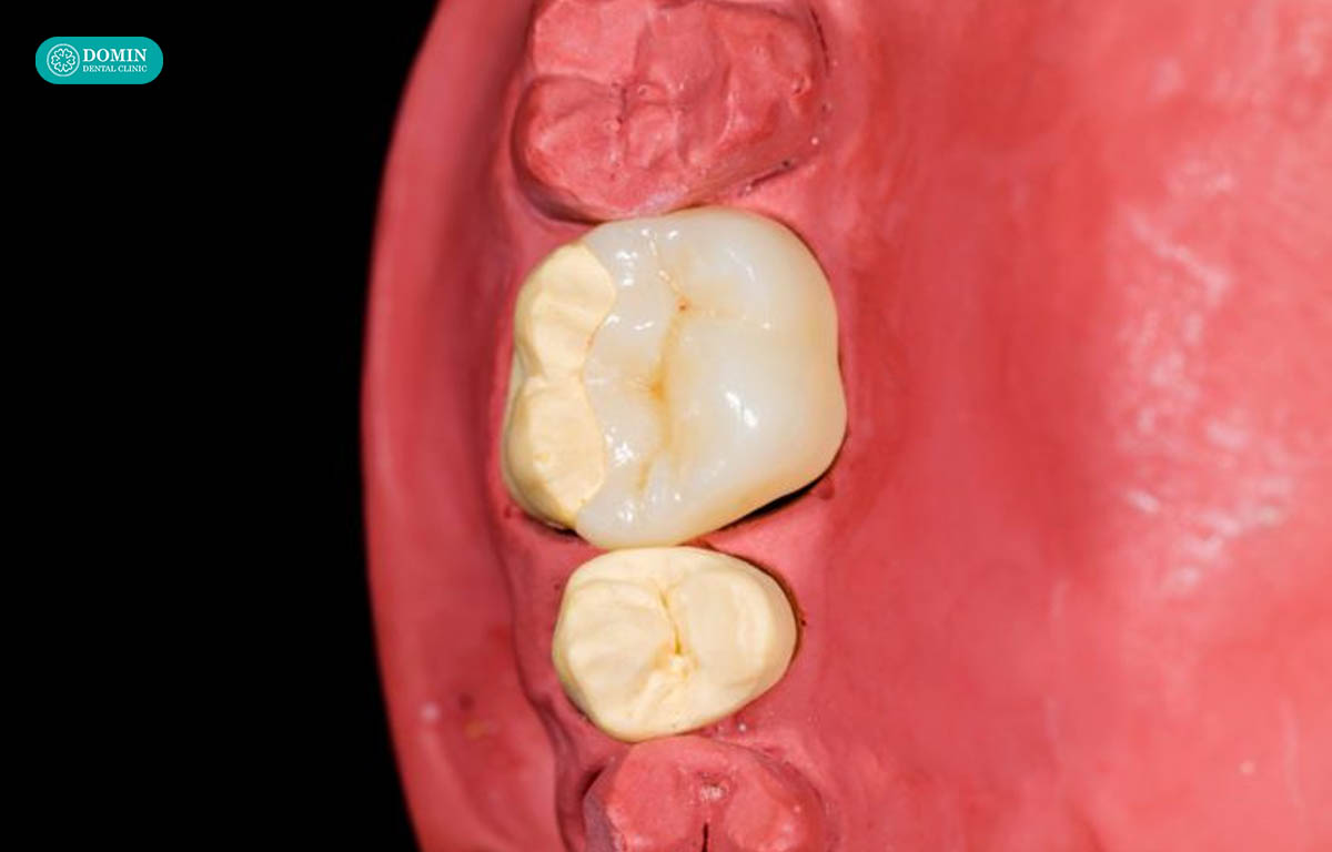 Về nguyên tắc, răng hàm vẫn có thể thực hiện dán sứ veneer
