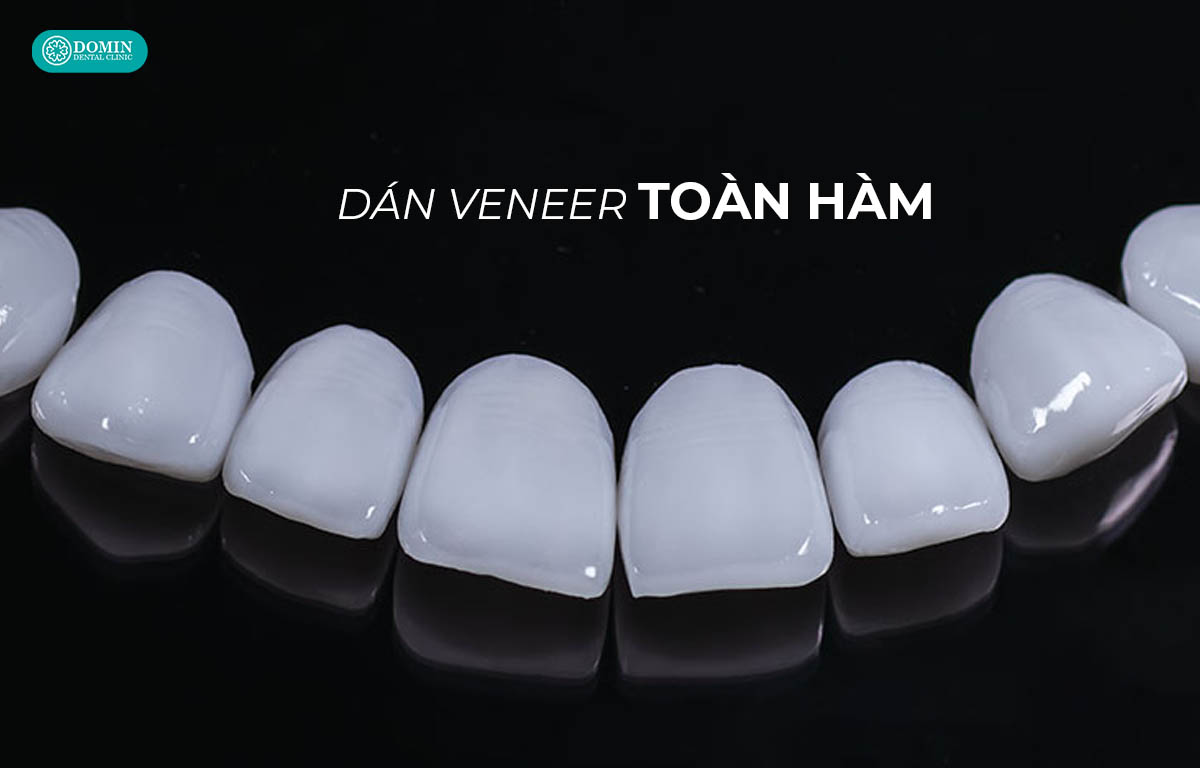 Dán sứ toàn hàm thực hiện bằng cách phủ veneer lên toàn bộ bề mặt ngoài của răng vùng cười.