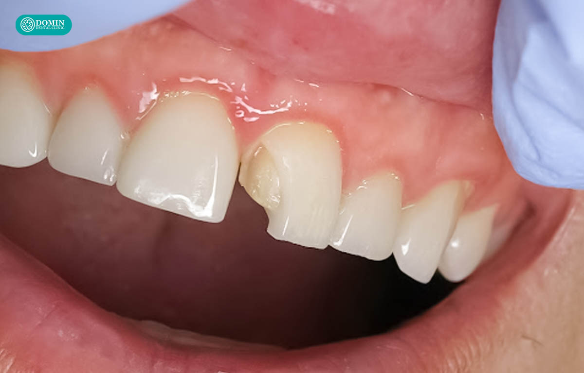 Nếu dán sứ sai cách, dễ gây tình trạng bong tróc