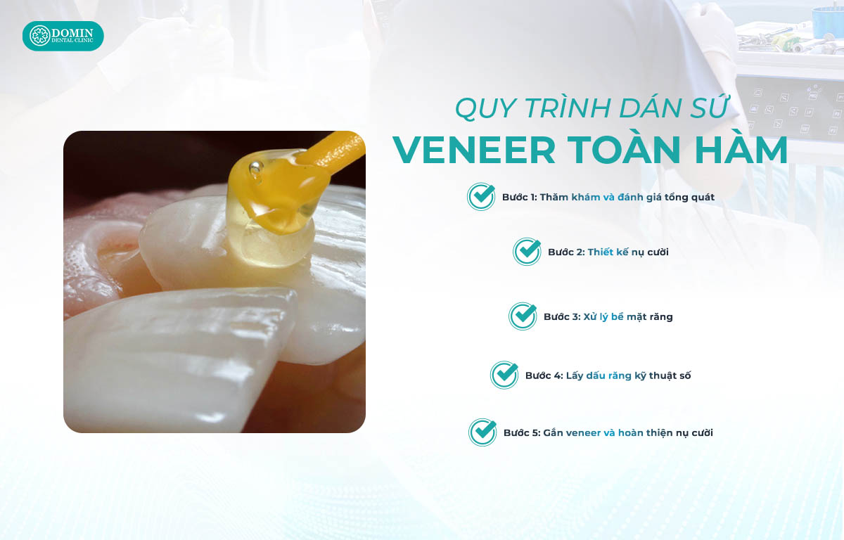 Quy trình dán sứ veneer toàn hàm đảm bảo nghiêm ngặt với 5 bước