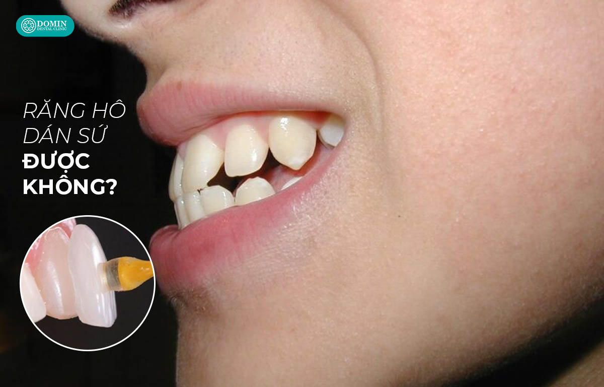 Dán sứ veneer cho răng hô nên thực hiện hay không?