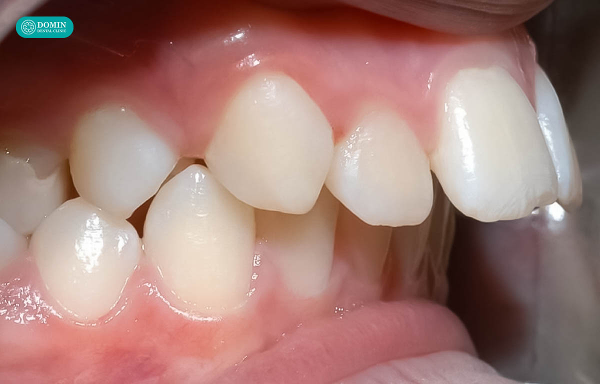 Răng hô trung bình hoặc nặng không nên áp dụng dán sứ veneer.