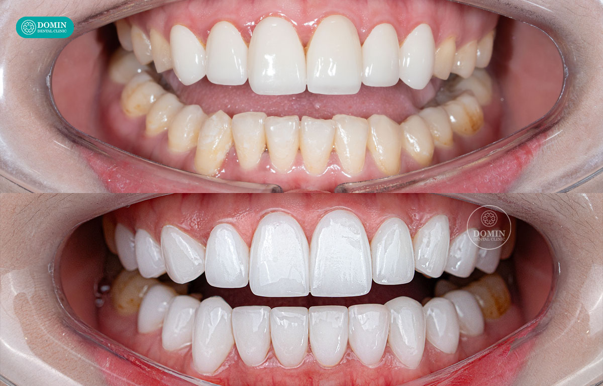 Veneer mang lại hiệu quả thẩm mỹ tự nhiên
