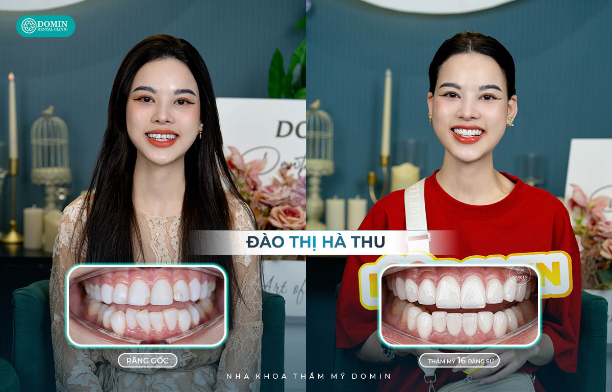 Thẩm mỹ vượt trội là ưu điểm rõ ràng nhất khi thực hiện dán veneer