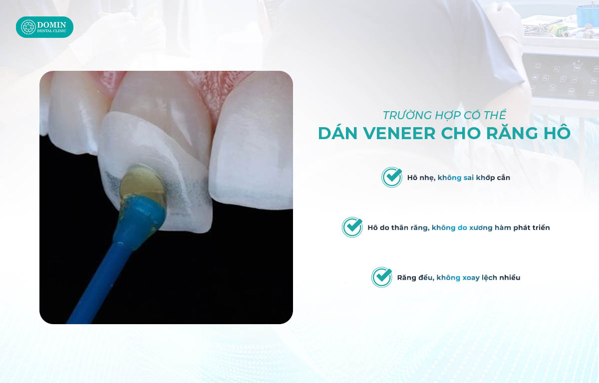 Trường hợp có thể áp dụng dán sứ veneer cho răng hô.