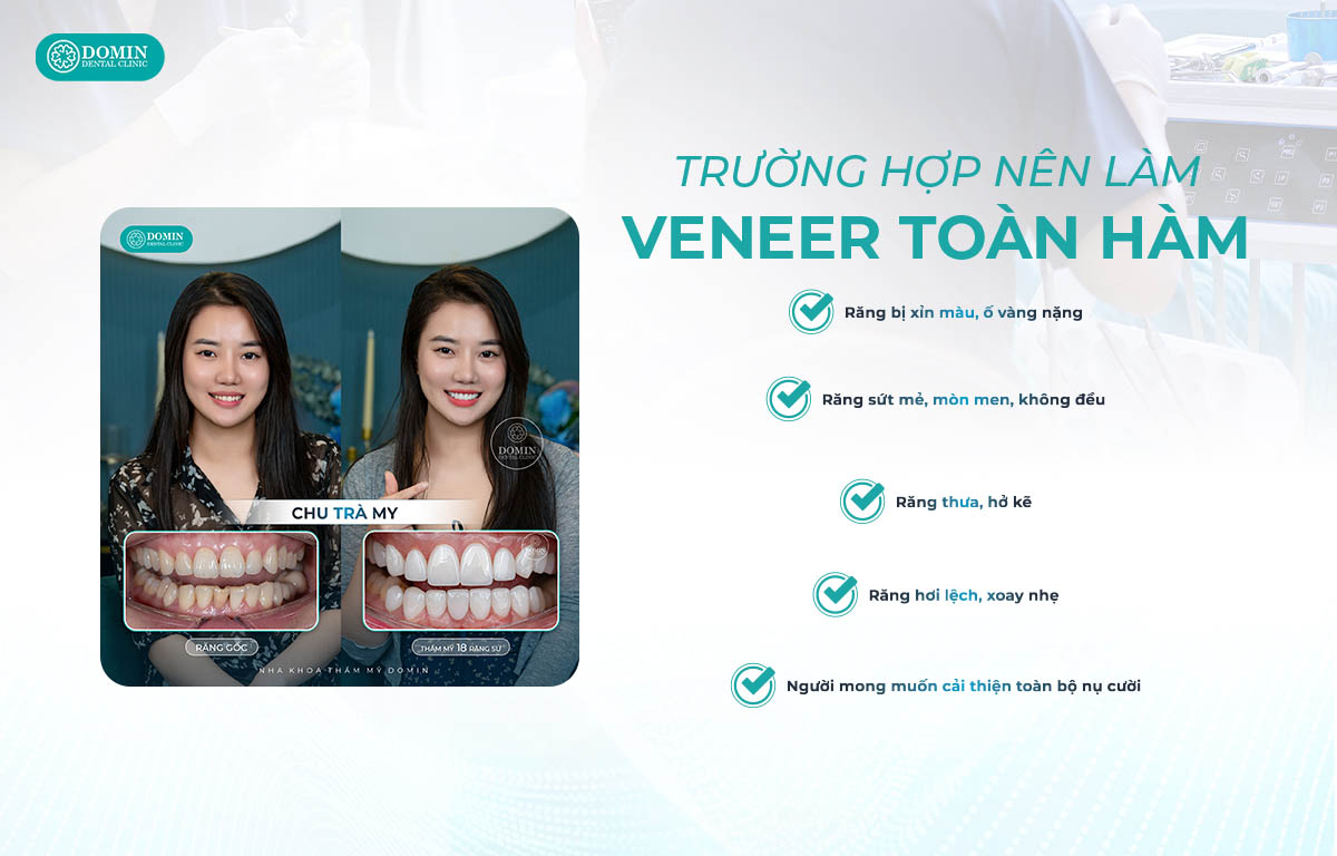 Các trường hợp điển hình có thể dán sứ veneer toàn hàm.