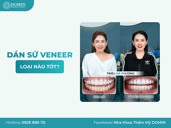 Dán Răng Sứ Loại Nào Tốt Nhất? 4 Loại Veneer Hot Nhất