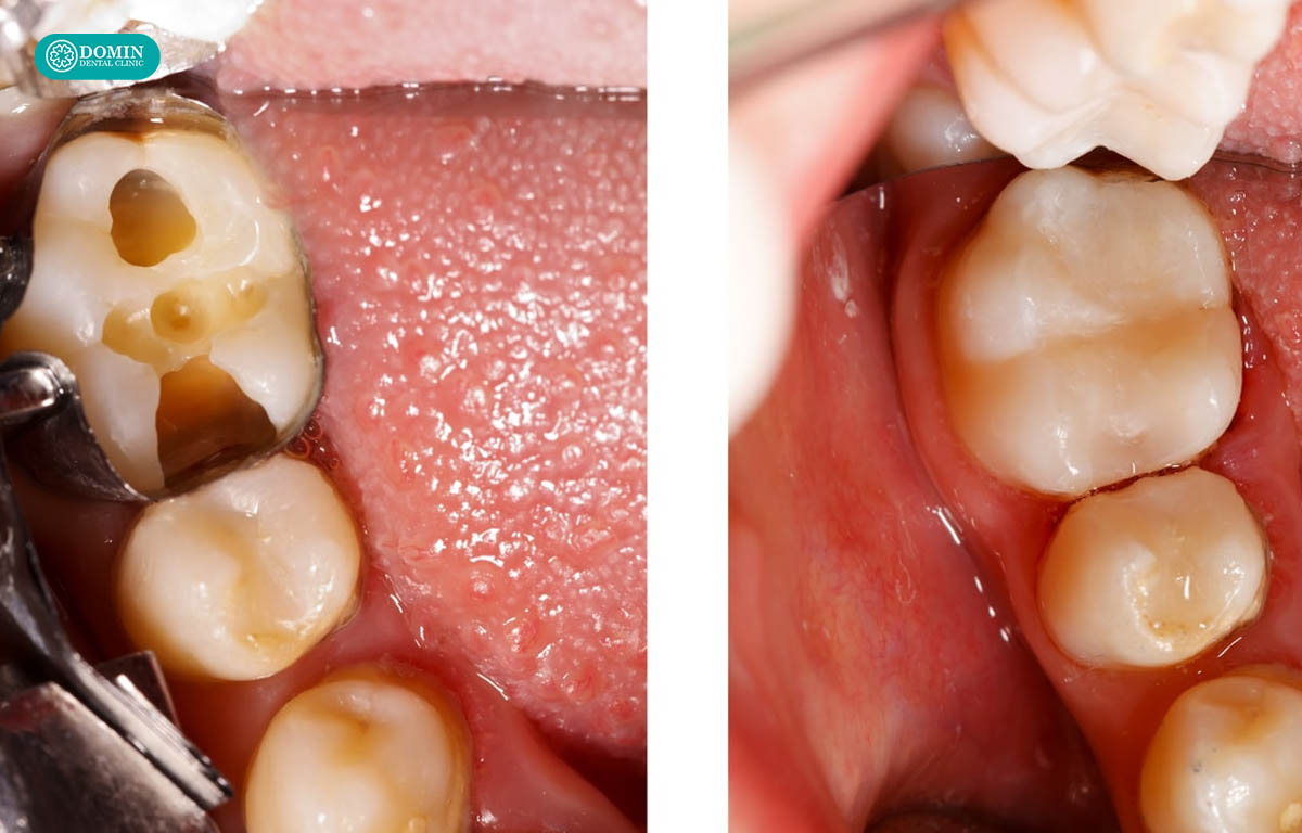 Inlay sứ dùng cho trường hợp có lỗ sâu lớn.