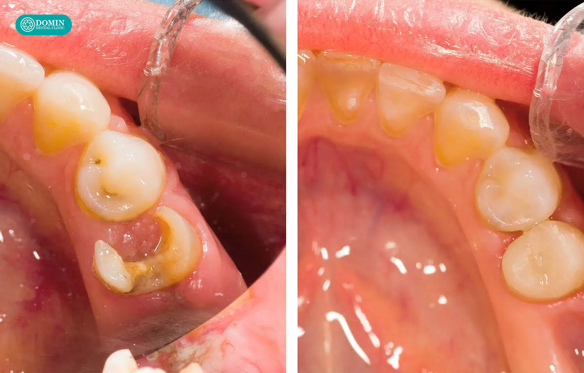 Thẩm mỹ vượt trội, khó phát hiện ra nhờ inlay sứ