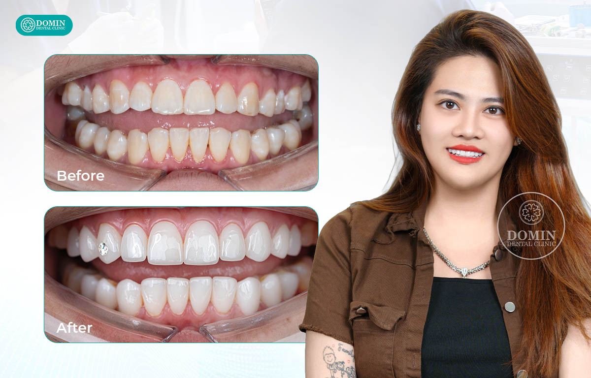 Veneer Zirconia mang lại nụ cười tươi sáng mà vẫn giữ được nét tự nhiên vốn có.