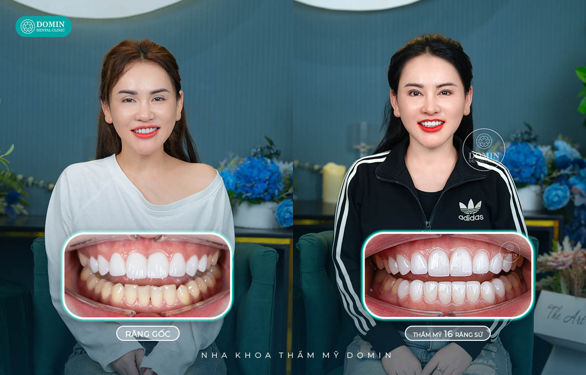 Nụ cười tự tin, rạng rỡ sau thực hiện dán sứ veneer.