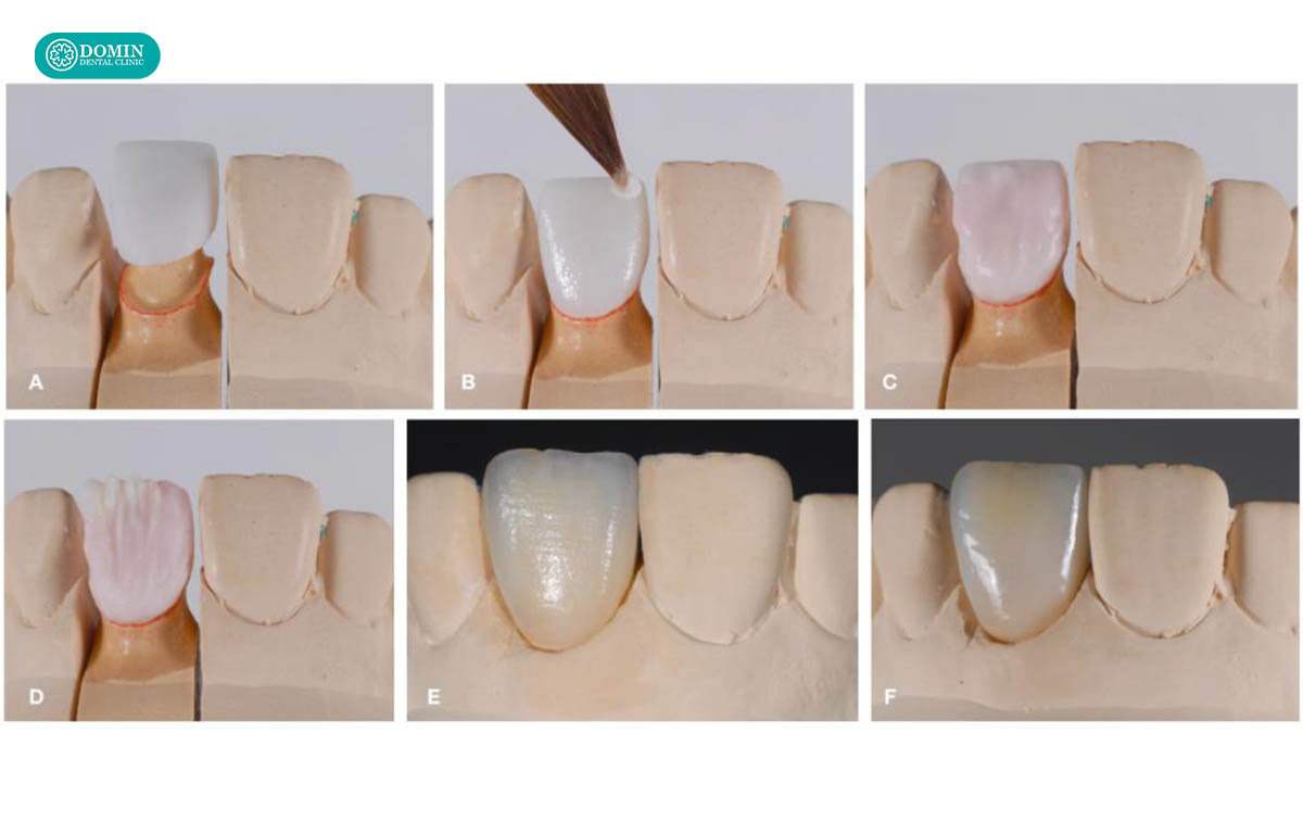 Công nghệ chế tác quyết định đến việc veneer Zirconia có bị xỉn màu không.