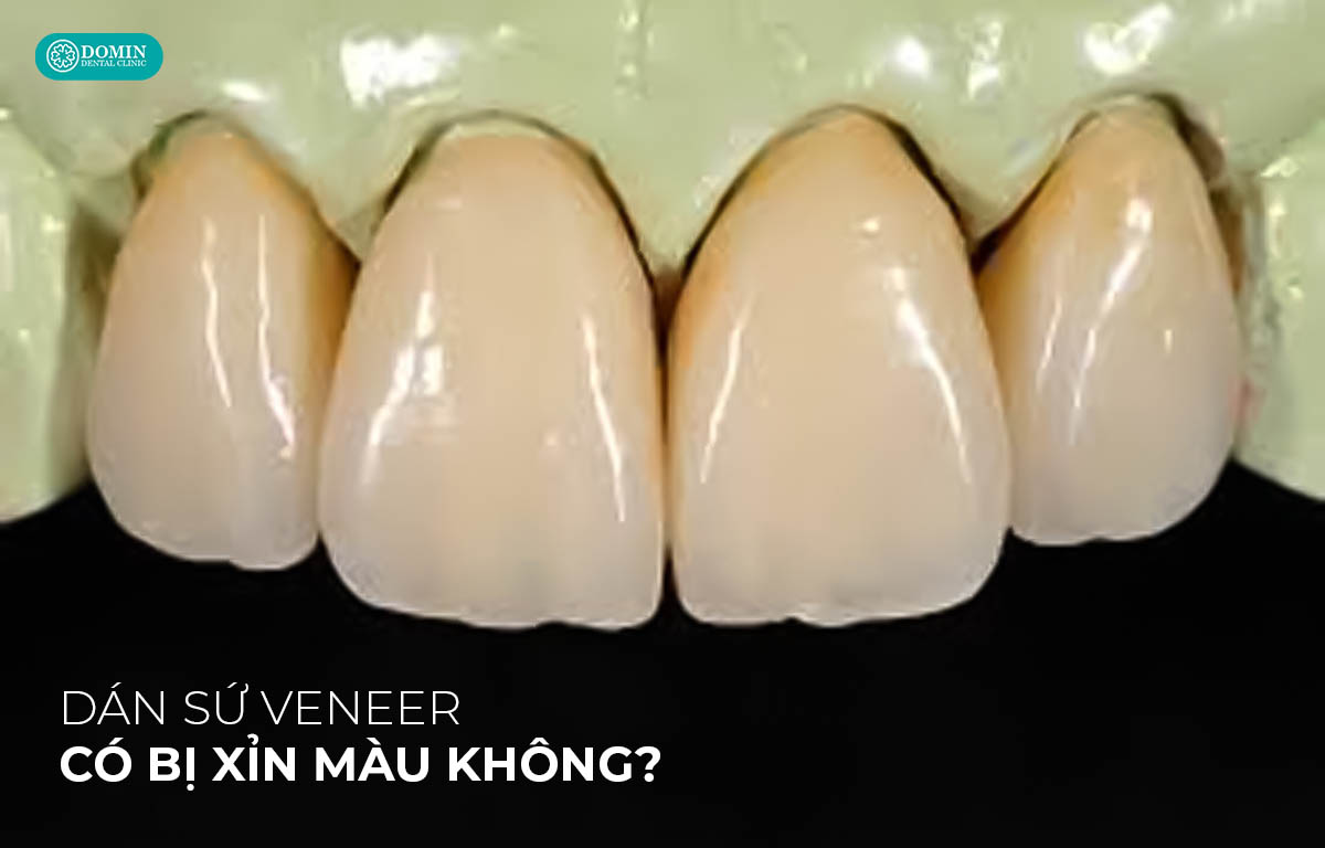 Dán sứ veneer sẽ không bị xỉn màu.