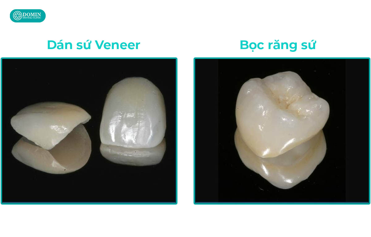 Veneer Zirconia và bọc sứ đều là phương pháp phục hình thẩm mỹ nhưng nó cũng có nhiều khác biệt.
