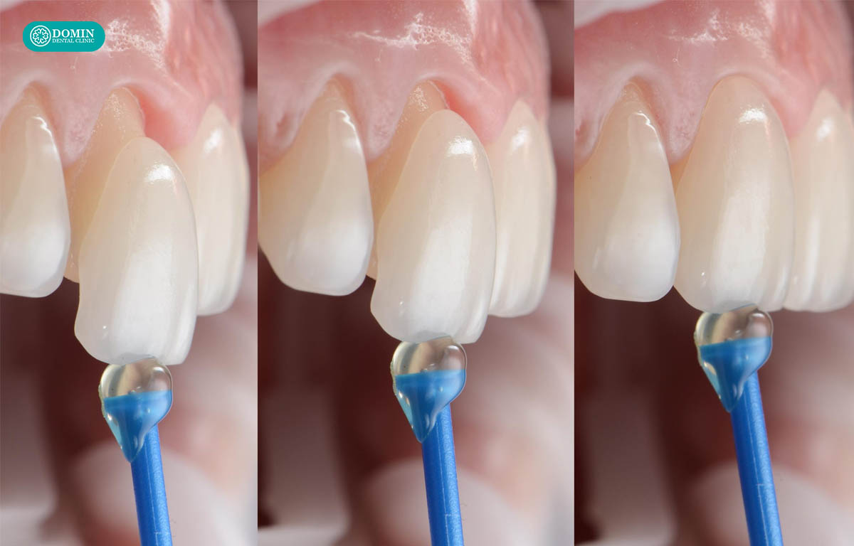 Thông thường, thời gian gắn hoàn thiện veneer zirconia khoảng 30-60 phút