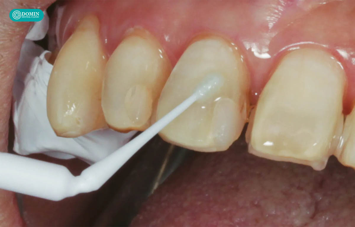 Sửa soạn men răng là cần thiết để tạo sự sát khít giữa răng thật và veneer.