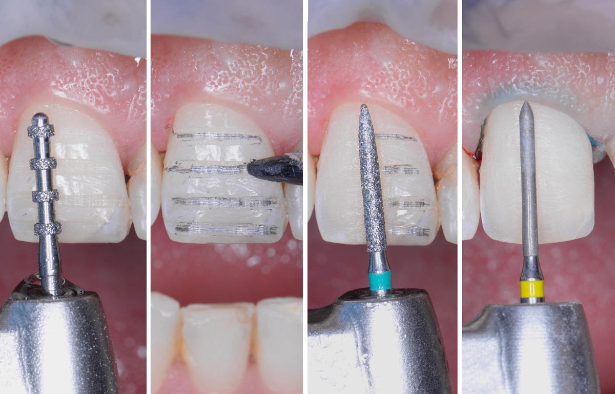 Bọc răng sứ sẽ đòi hỏi tỷ lệ mài răng nhiều hơn.