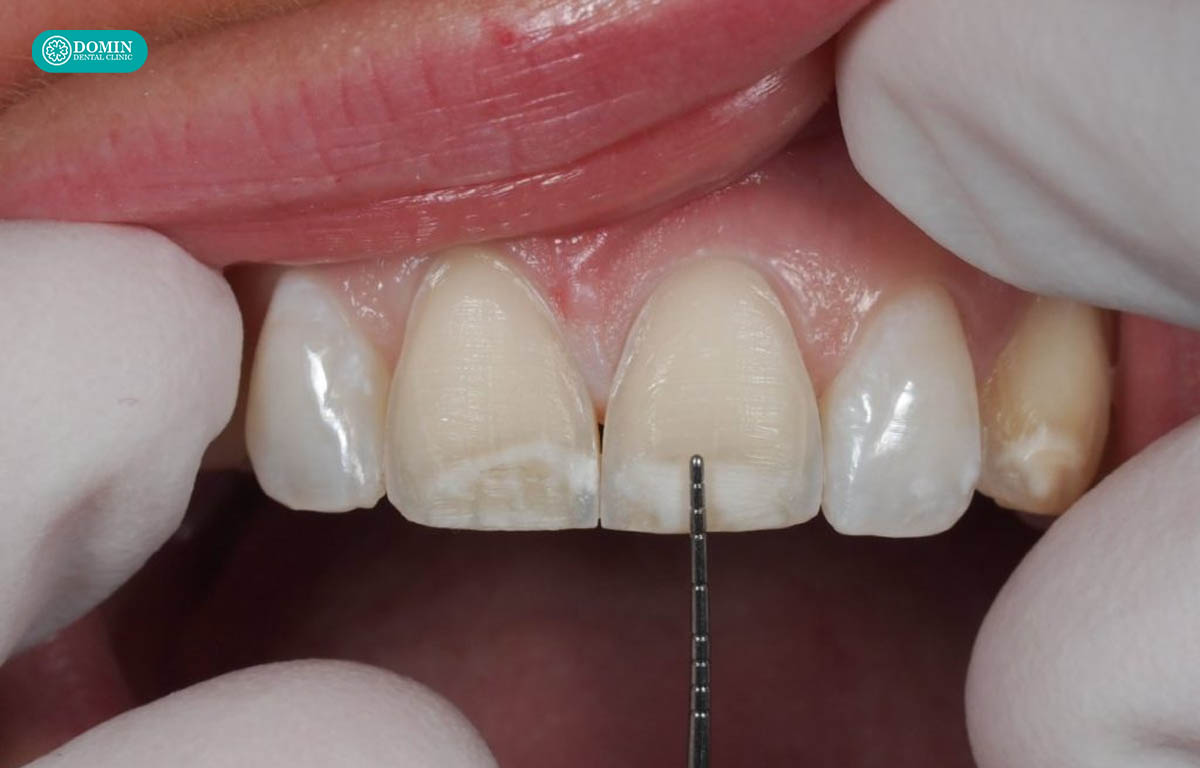 Mài trong dán Veneer Zirconia là điều cần thiết giúp veneer bám dính chắc chắn