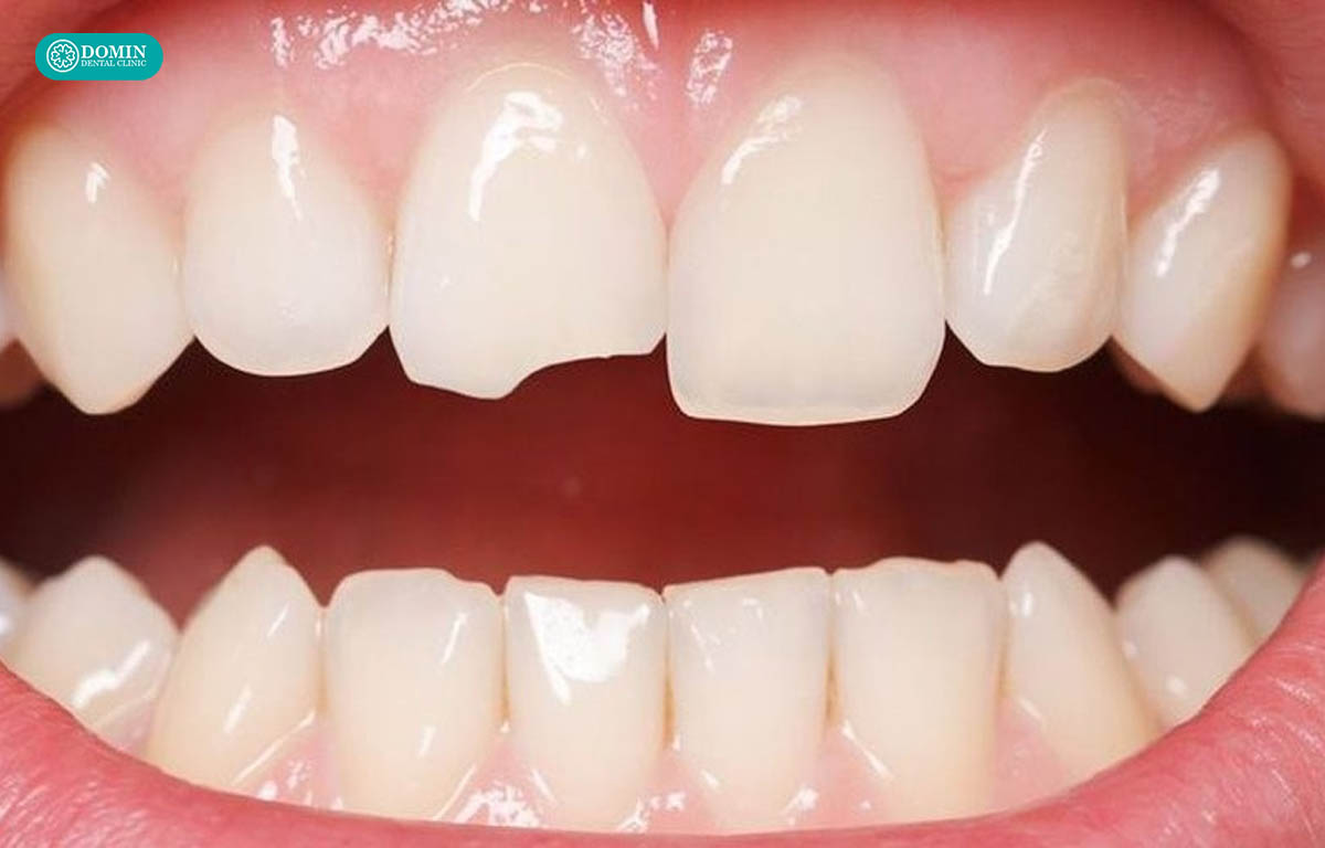 Răng nứt mẻ cải thiện hoàn toàn nhờ dán veneer Zirconia