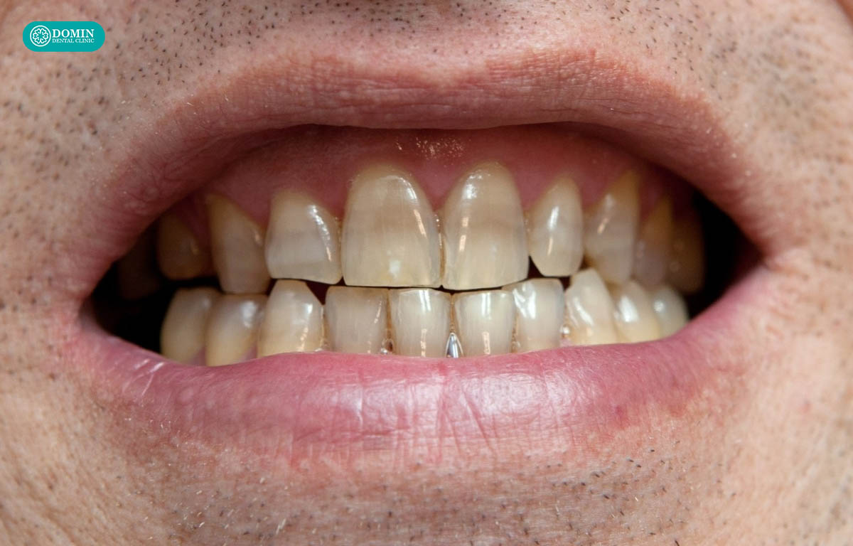 Dán veneer Zirconia phù hợp với trường hợp răng nhiễm màu.