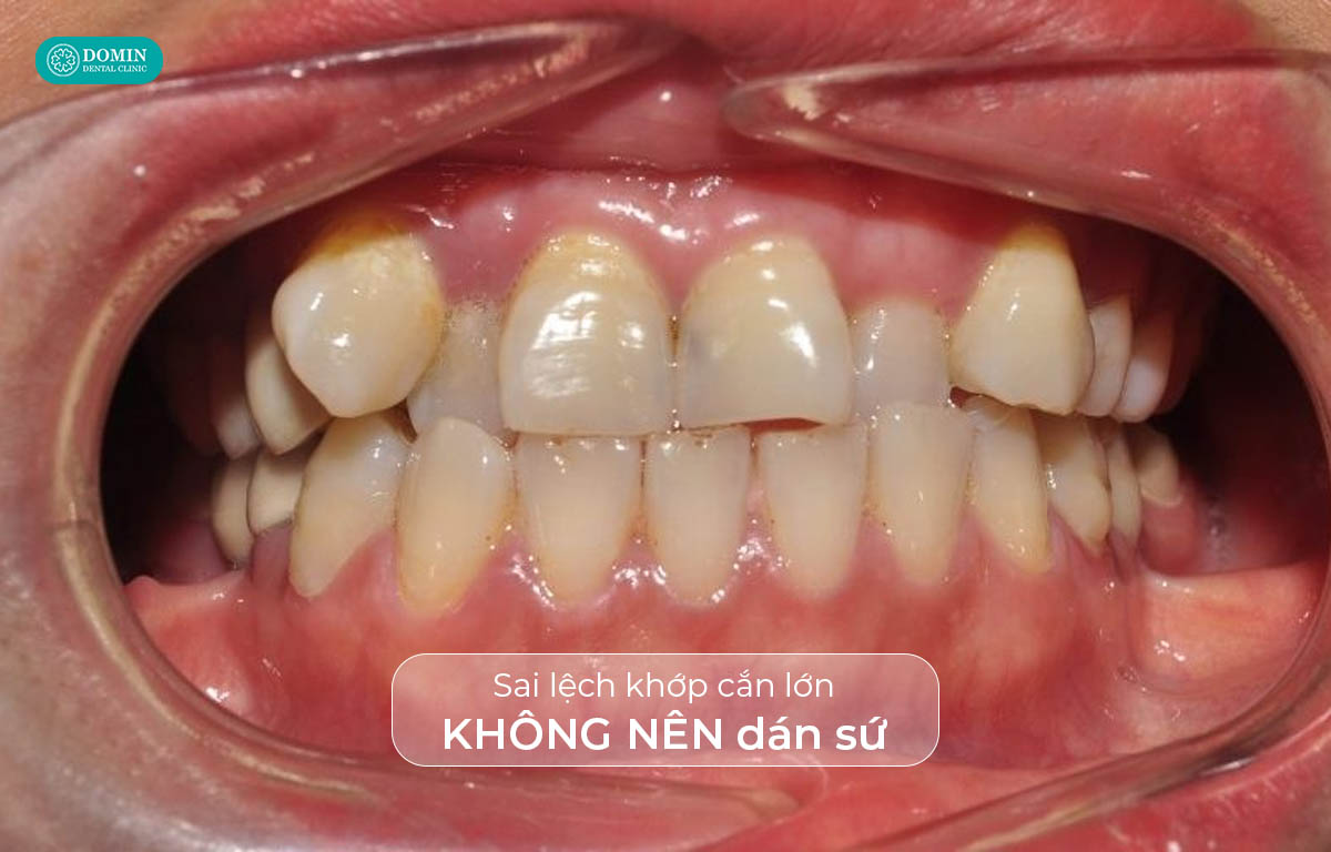 Răng sai lệch khớp cắn nhiều không nên áp dụng dán sứ.