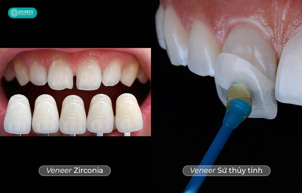 Mặt dán sứ thuỷ tinh có chi phí cao hơn so với dán sứ zirconia