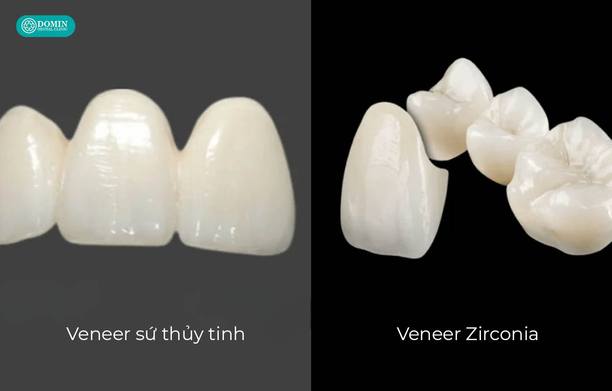 Veneer Zirconia vượt trội về khả năng che màu, còn veneer sứ thuỷ tinh siêu mỏng, hạn chế tối đa mài răng.