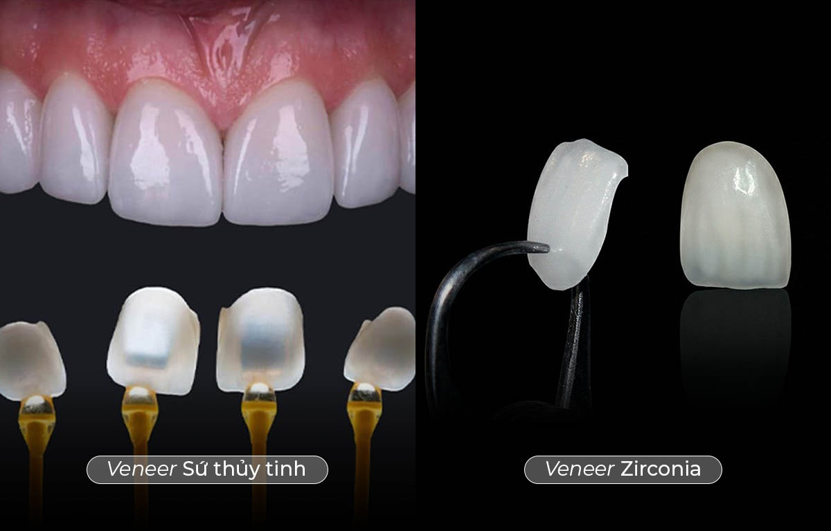 Cả veneer zirconia và veneer sứ thuỷ tinh đều có những ưu, nhược điểm riêng.