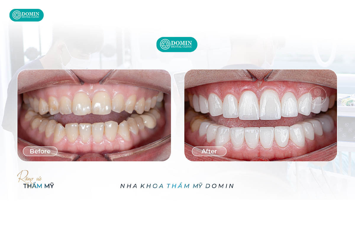 Nhiều khách hàng nhận định veneer zirconia gần như không có sự khác biệt so với răng thật.