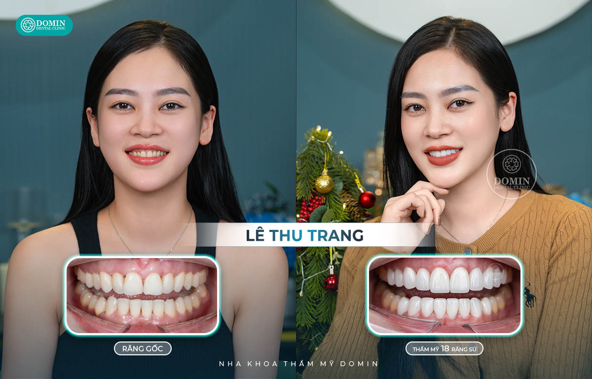 Bạn Lê Thu Trang cho rằng quyết định dán sứ là hoàn toàn đúng đắn.