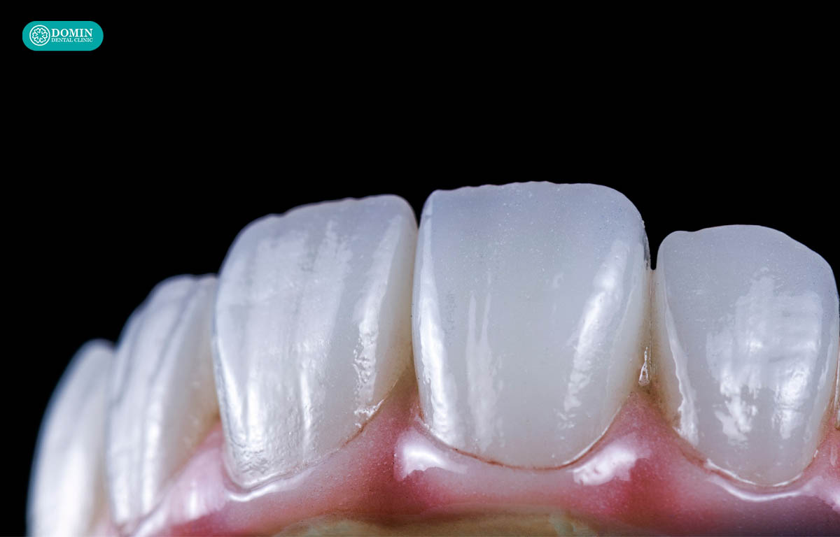 Veneer Zirconia DDBio đạt hiệu quả thẩm mỹ như răng thật