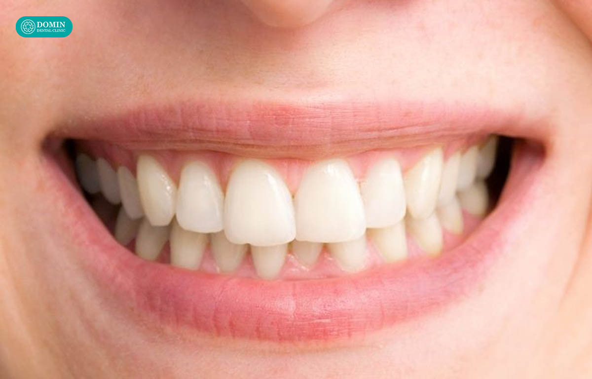 Răng sai lệch nhẹ bác sĩ có thể mài chỉnh một chút để đủ không gian dán sứ