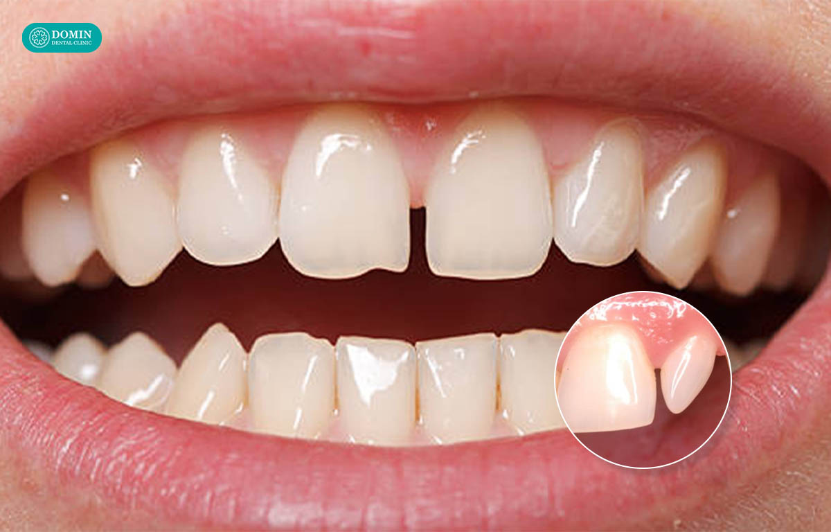 Trường hợp răng thưa, kẹ bác sĩ sẽ chỉ định dán sứ mà không cần mài răng