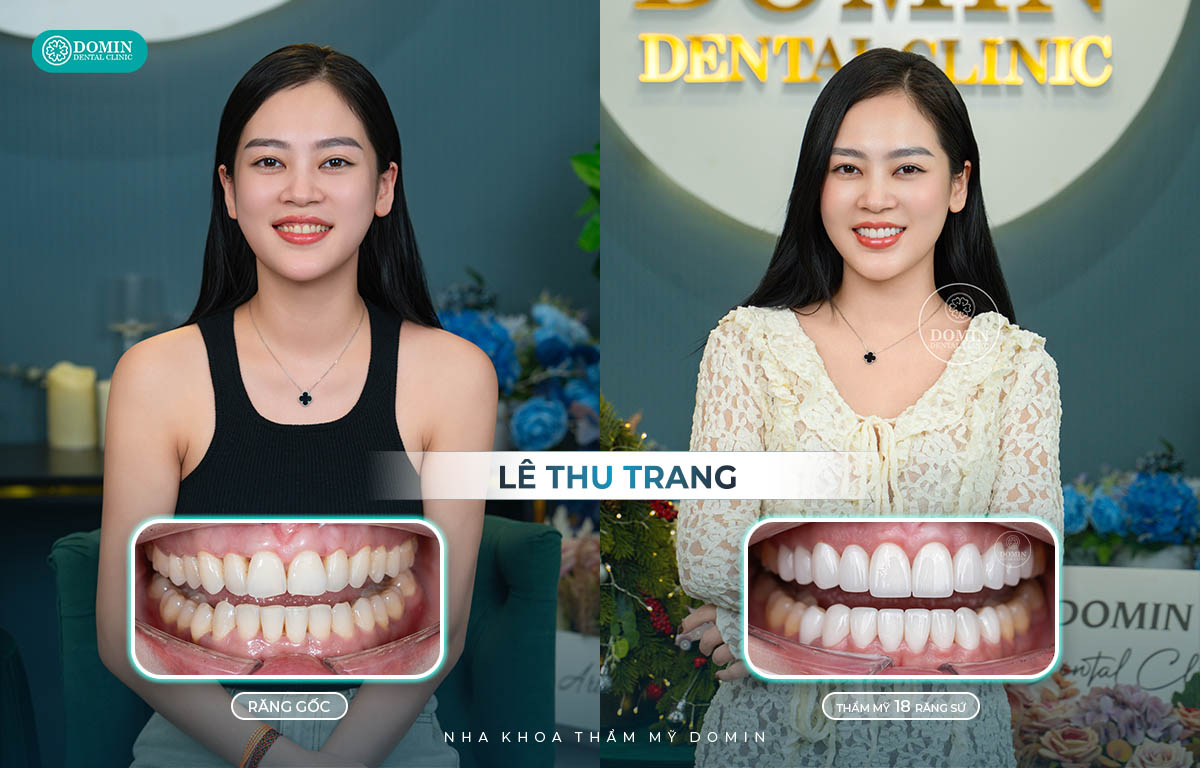 Nếu mài chỉnh đúng kỹ thuật, việc dán sứ veneer sẽ mang đến kết quả thẩm mỹ cũng như độ an toàn tuyệt đối.
