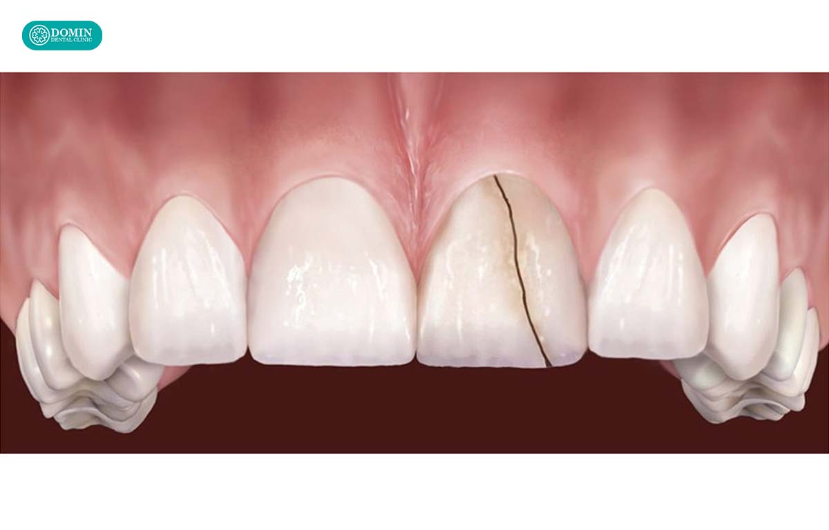 Mặt dán sứ có thể nứt vẻ nếu sử dụng vật liệu kém chất lượng.