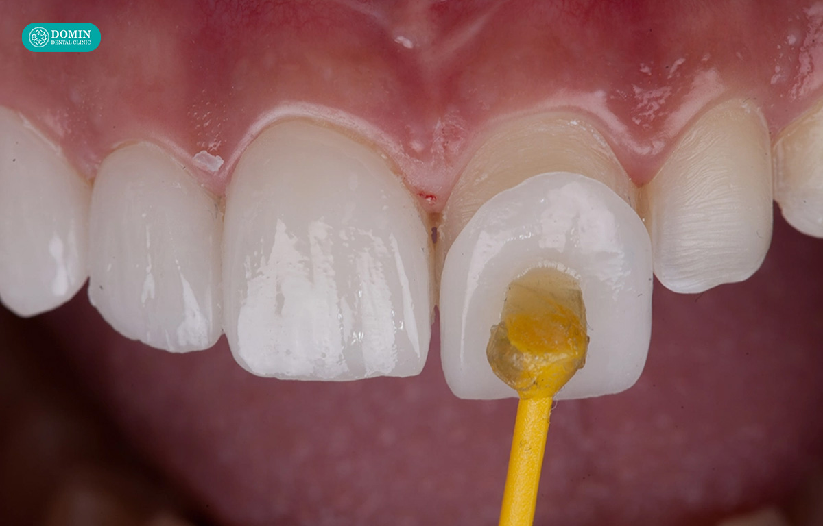 Dán sứ DDBio gần như không đau nếu được làm đúng kỹ thuật