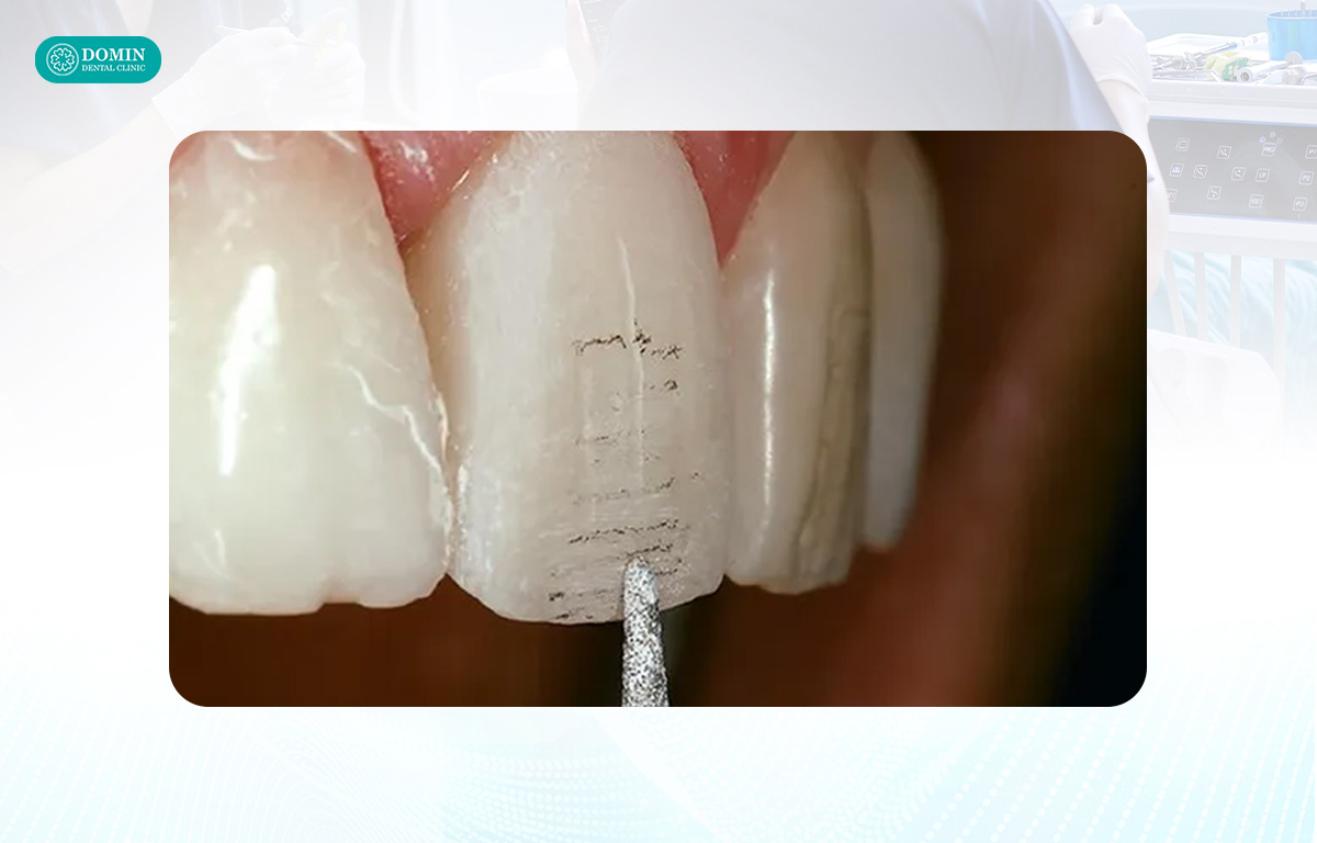 Mài chỉnh bề mặt răng không gây đau do chỉ tác động phía mặt ngoài.