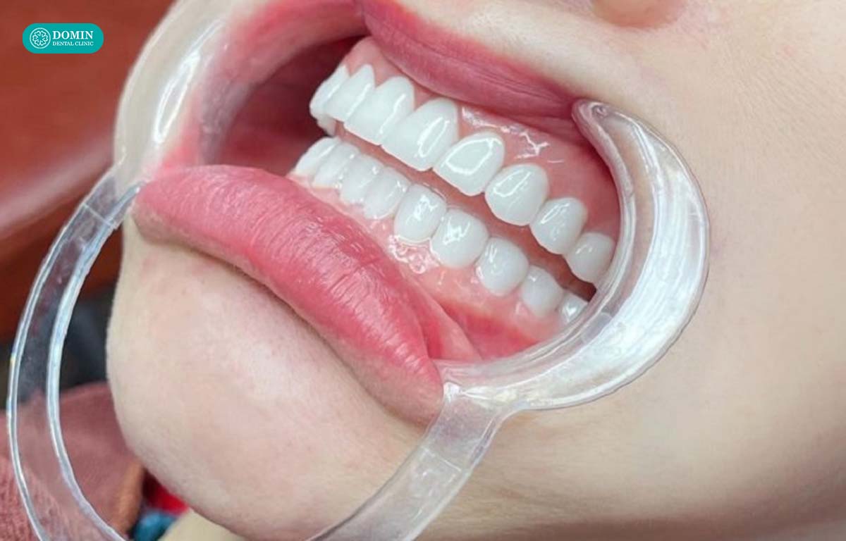 Trường hợp răng đều không cần thực hiện mài răng dán sứ.