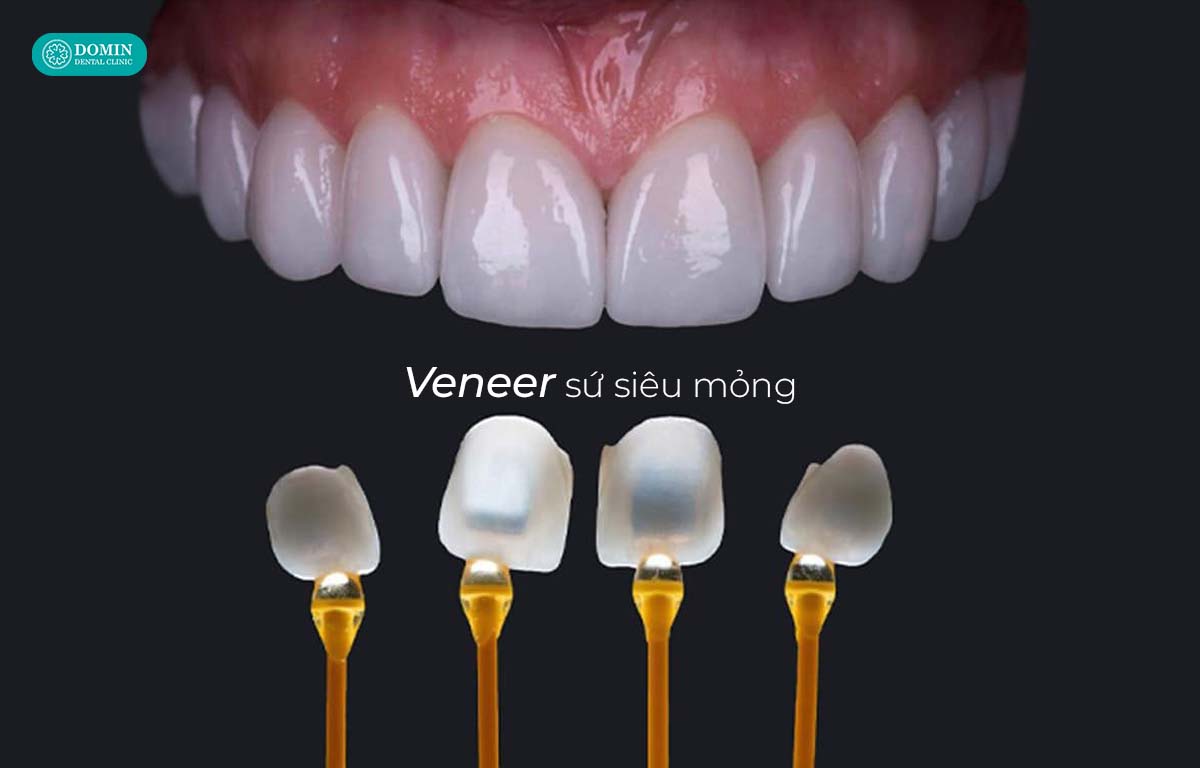 Dán sứ veneer siêu mỏng sử dụng lớp sứ độ dày chỉ khoảng 0.2 - 0.5mm