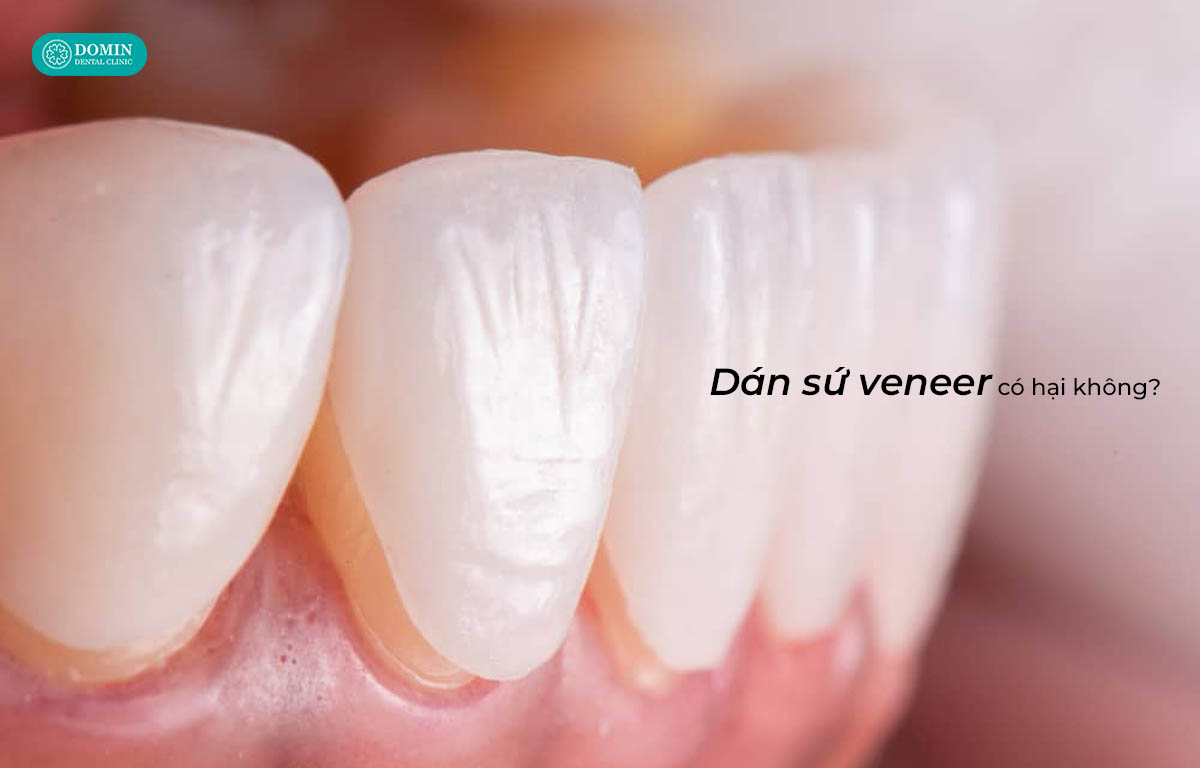 Về bản chất, dán sứ veneer không gây hại nếu được làm đúng.