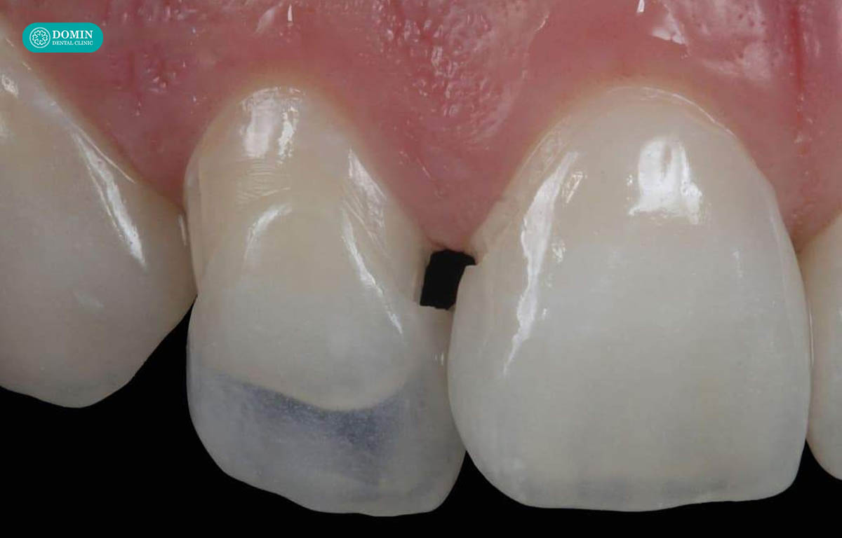 Dán sứ không mài hoàn toàn có thể bền từ 15-20 năm