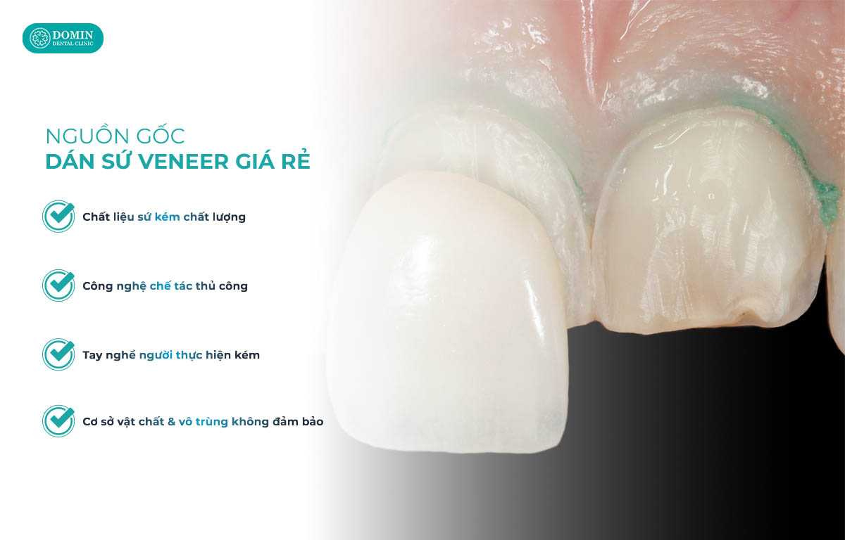 Dán sứ veneer giá rẻ do nhiều nguyên nhân khác nhau.