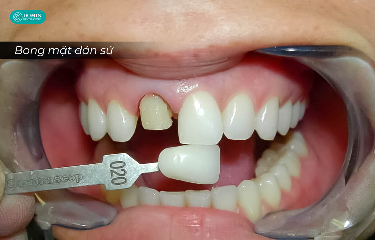 Bong hoặc rơi mặt dán sứ khá thường gặp, nguyên nhân do sử dụng vật liệu không đảm bảo, quy trình chế tác không đúng ...